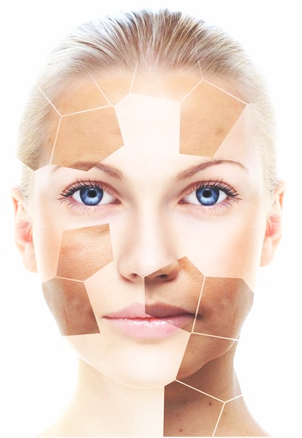 Microdermabrasion