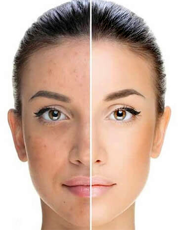 Microdermabrasion